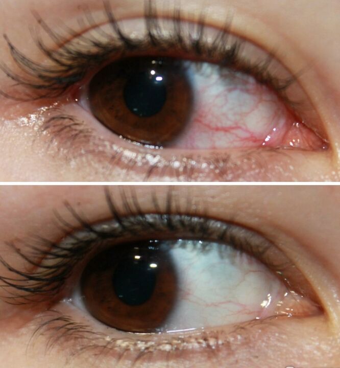 Ocuvit tegutseb väga kiiresti