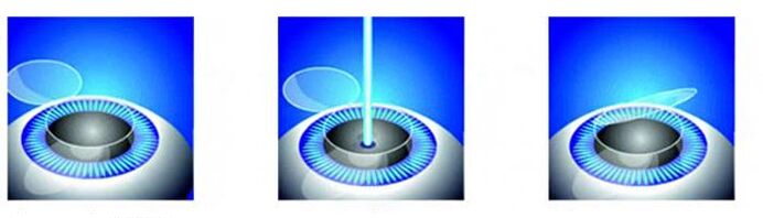 Laser nägemise korrigeerimise etapid